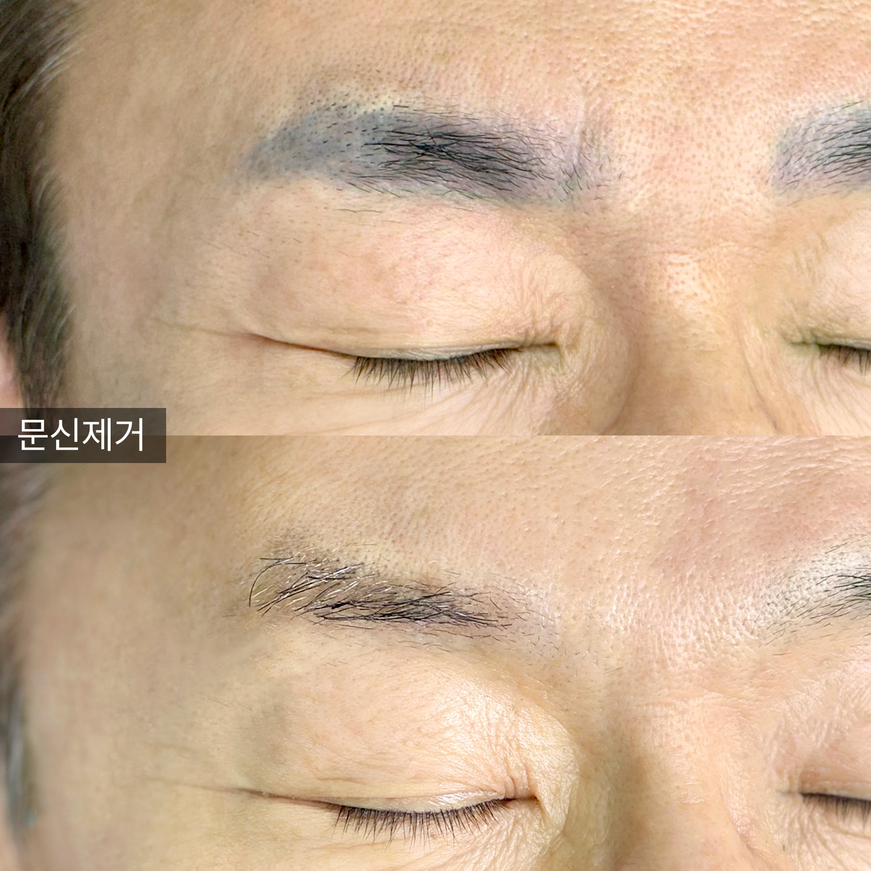 잔흔 제거