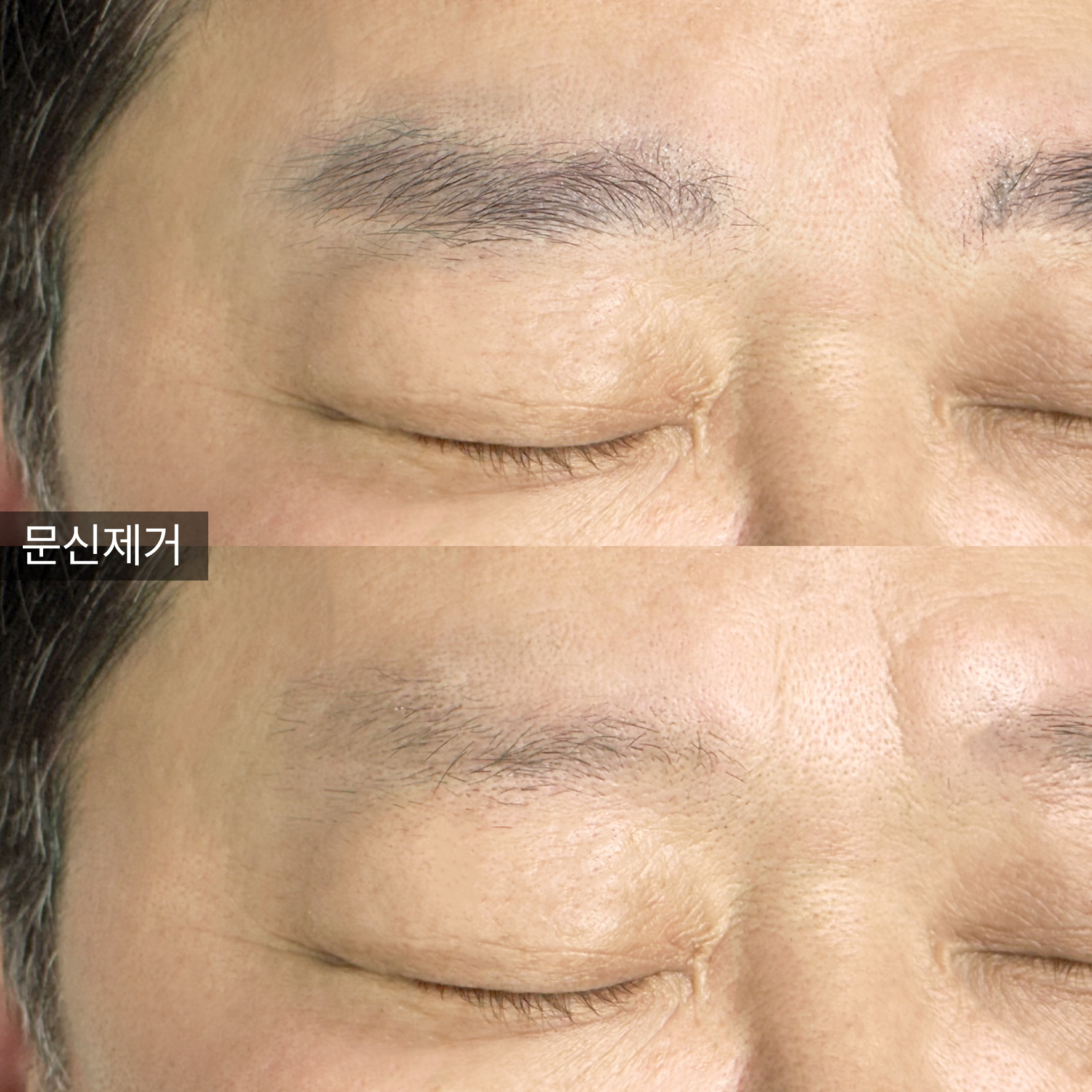 잔흔 제거