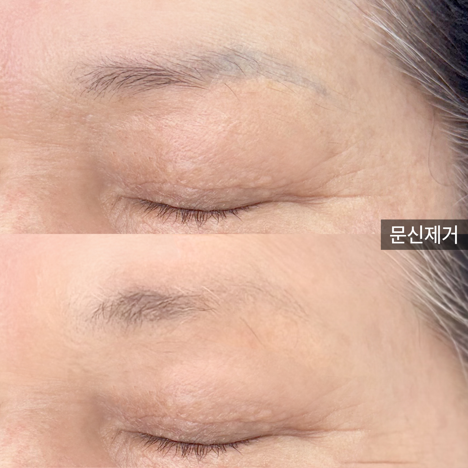 잔흔 제거